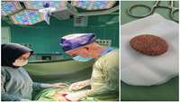 جراحی موفقیت آمیز فوق تخصصی Cystolithotomy در مرکز آموزشی پژوهشی و درمانی کوثر