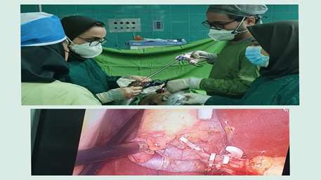  جراحی لاپاراسکوپی کیسه صفرا توسط دکتر سلطانی متخصص جراحی عمومی وحضور دستیاران جراحی در بیمارستان کوثر