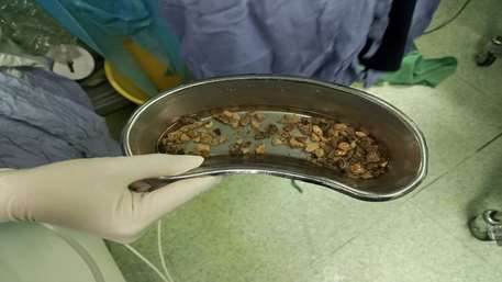  عمل جراحی موفق PCNL در مرکز آموزشی پژوهشی و درمانی کوثر